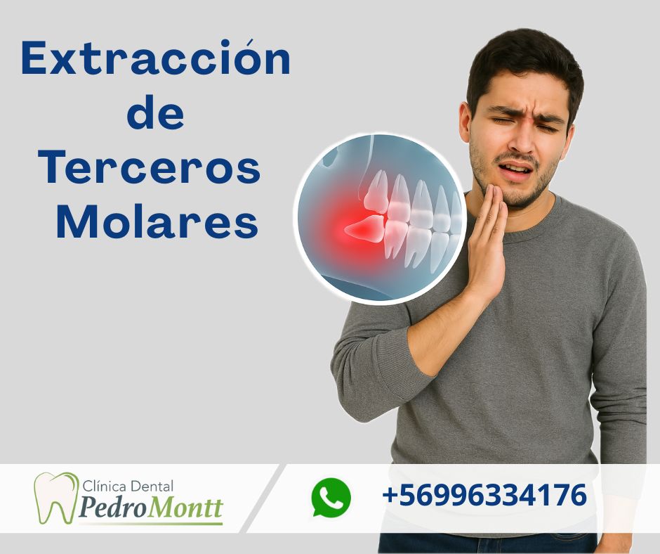 Extracción Terceros Molares