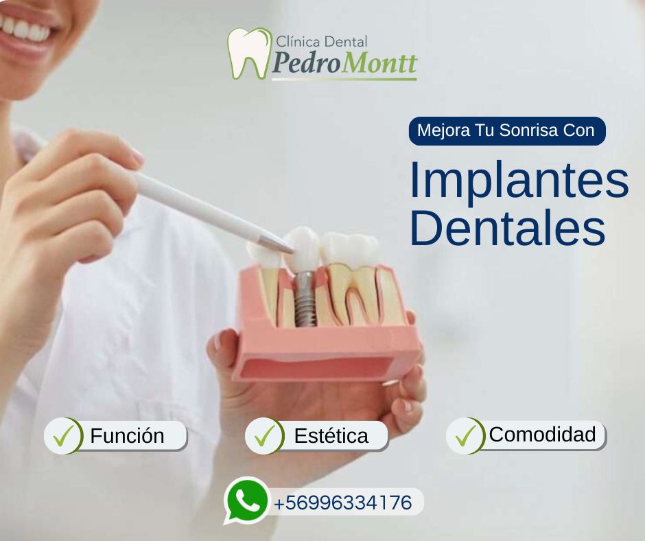 implantes dentales.jpg