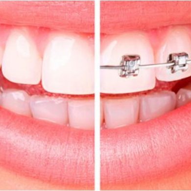 dientes antes y despues de instalar frenillos